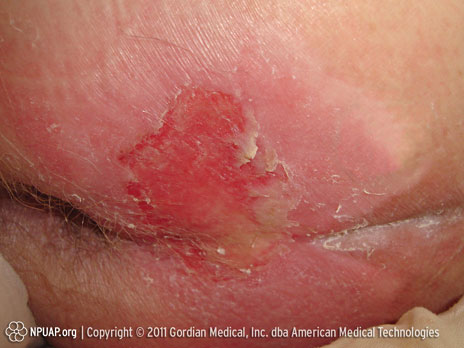 Κατηγορία/Στάδιο ΙΙ έλκους από κατάκλιση: Απώλεια μερικού πάχους δέρματος ή φλύκταινα 